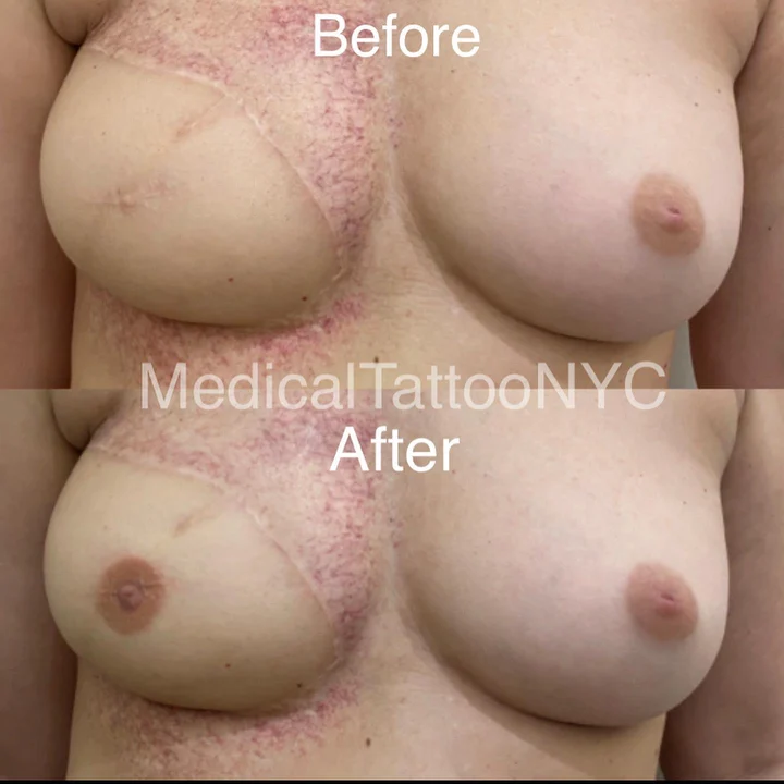 Nipple and areola tattoo result