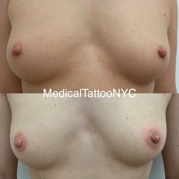 Nipple and areola tattoo result