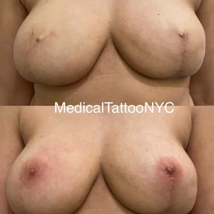 3D nipple-areola tattoo after breast reconstruction