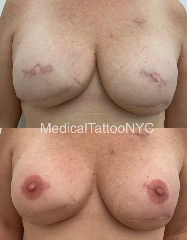 Nipple and areola tattoo result