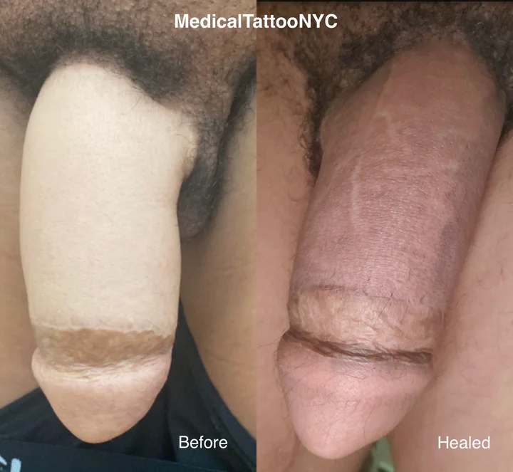 Phalloplasty tattoo result