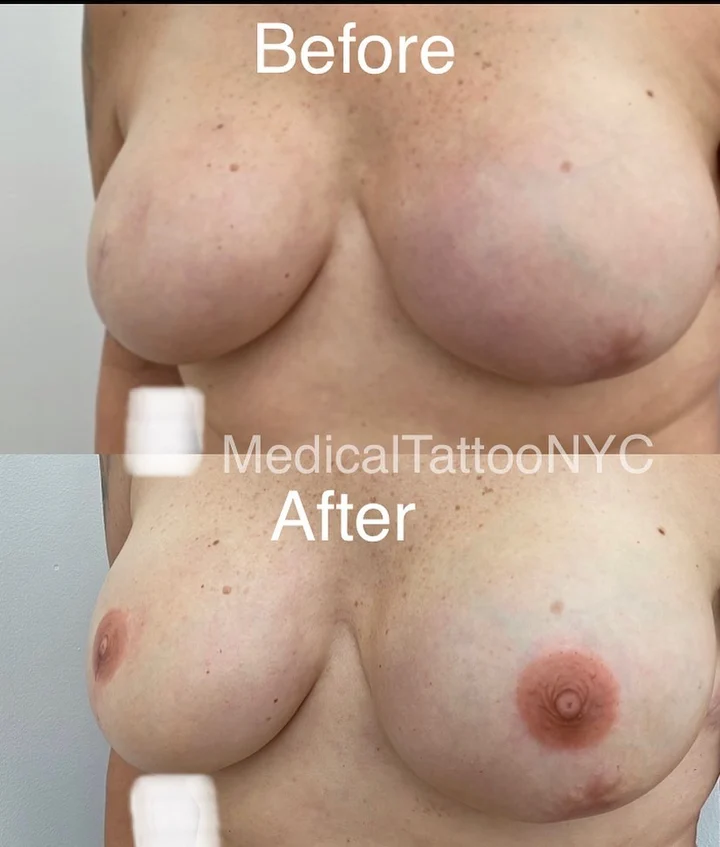 Nipple and areola tattoo result