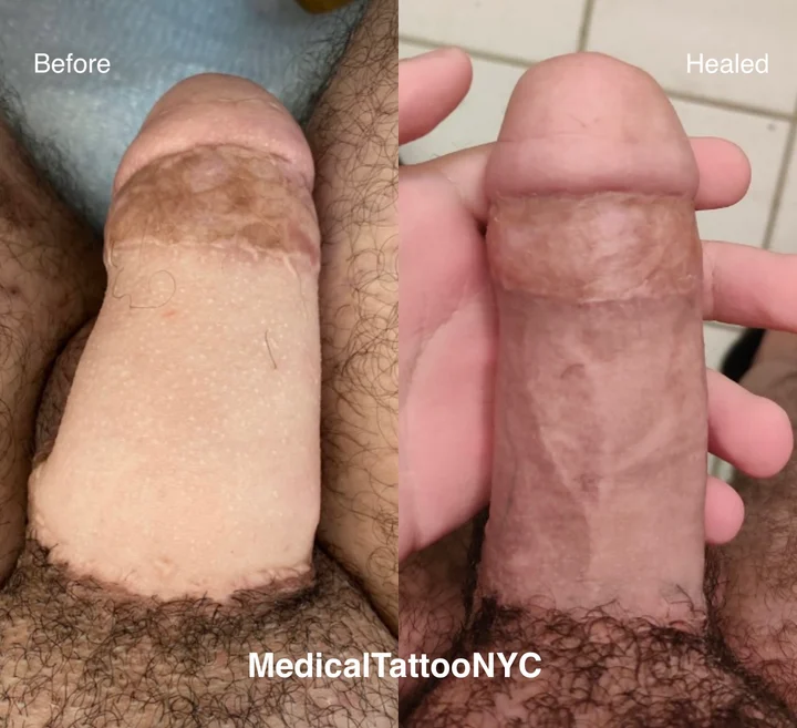 Phalloplasty tattoo result