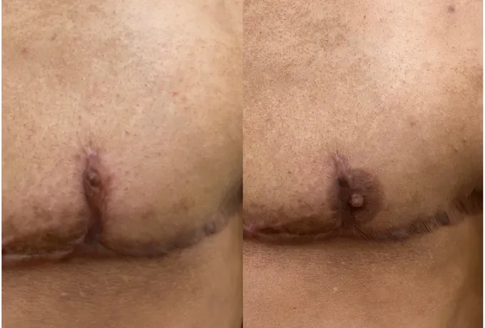 Top surgery chest tattooing