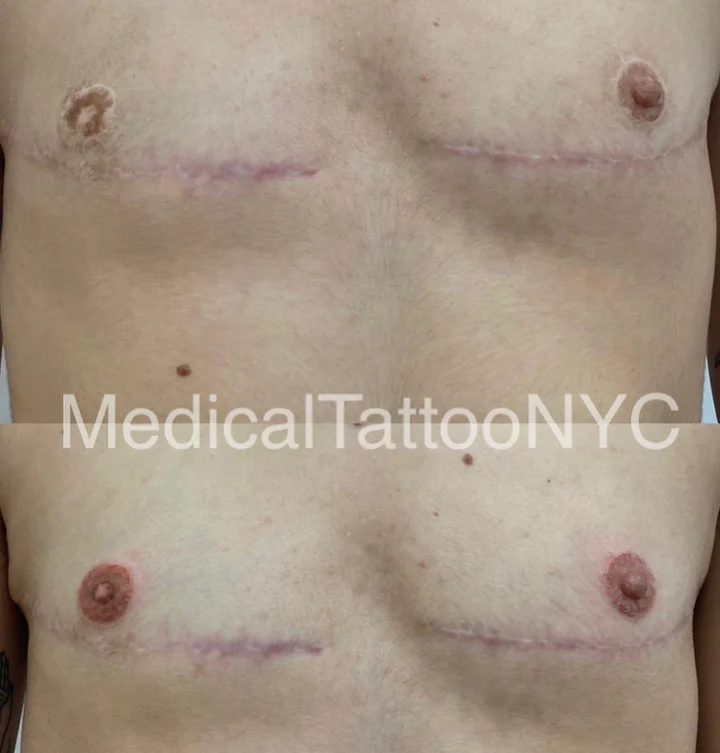 Top surgery tattoo result