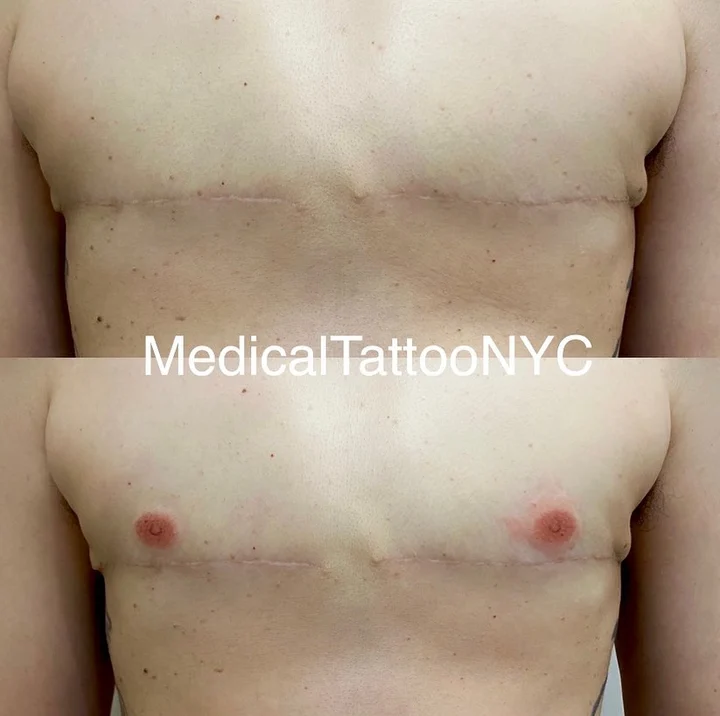 Top surgery tattoo result