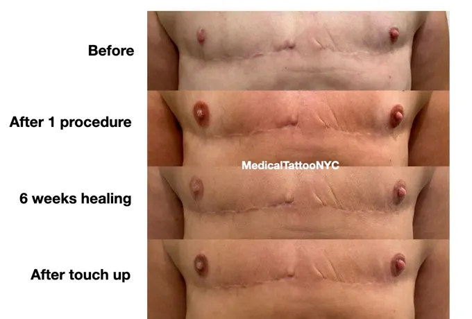 Top surgery chest tattooing