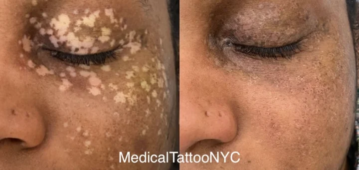 Scar camouflage tattoo result