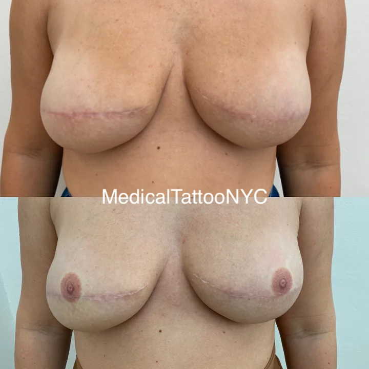 Nipple and areola tattoo result