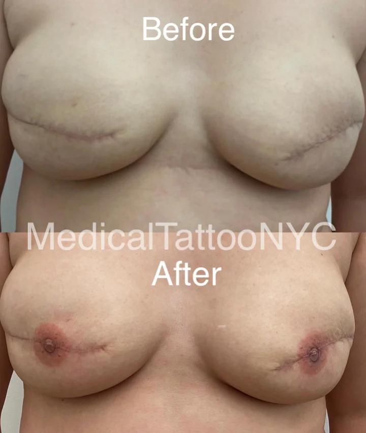 Nipple and areola tattoo result