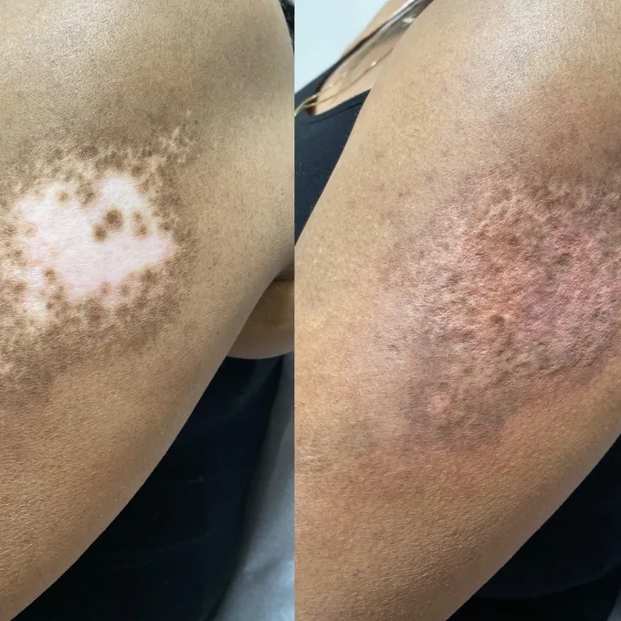 Scar camouflage before and after