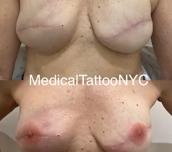 3D nipple-areola tattoo after breast reconstruction