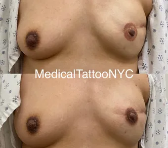 3D nipple-areola tattoo after breast reconstruction
