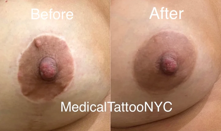 Scar camouflage tattoo result