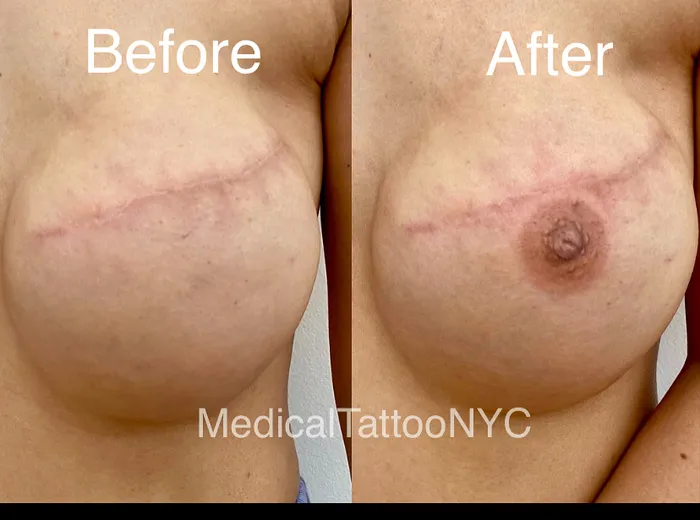 What Is Medical Tattooing?