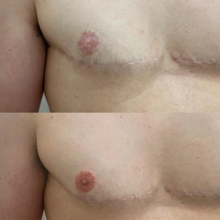 Top surgery tattoo result